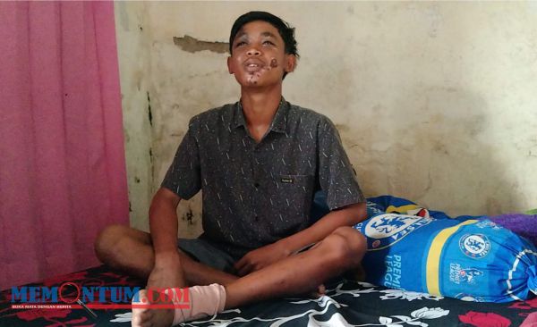 Nur Saguwanto, Korban Selamat Tragedi Kanjuruhan dengan Kondisi Luka Serius hingga Patah Kaki serta Sisakan Hutang Rp 750 untuk Perawatan